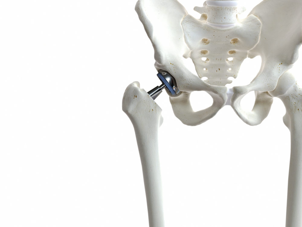 大腿骨頸部骨折での人工骨頭置換術の写真