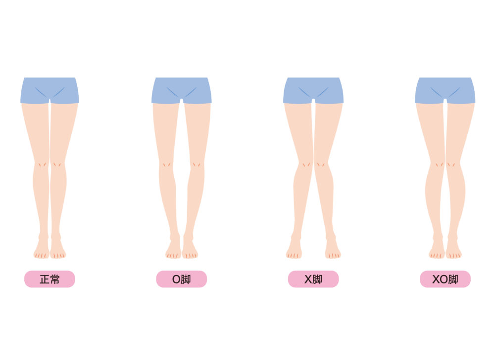 変形性膝関節のタイプ別一覧